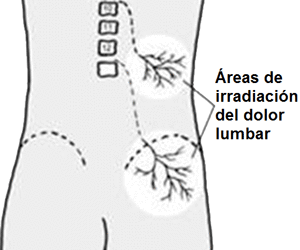 El Síndrome Facetario Lumbar