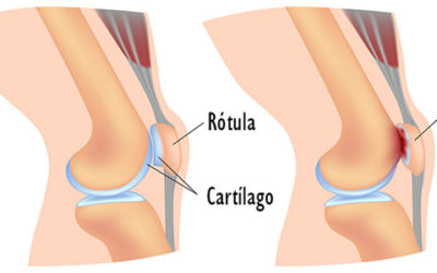 ¿Qué es la Condropatía Rotuliana?