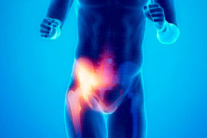 Pubalgia o hernia del deportista